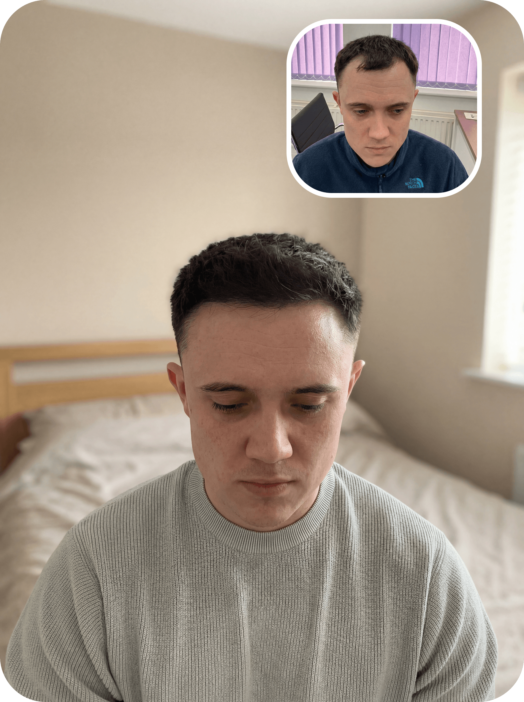 Daniel's hair regrowth progress