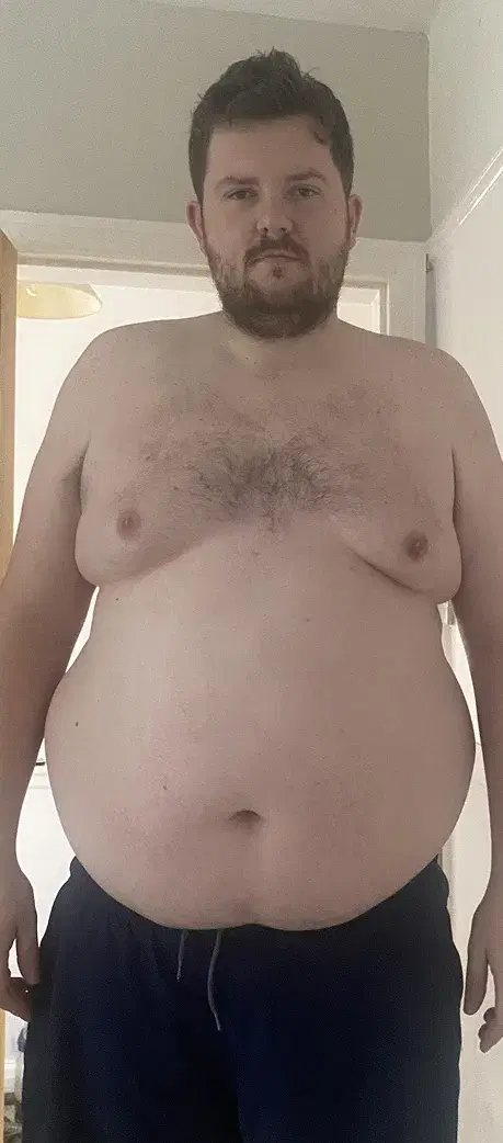 Oliver before weight loss treatment
